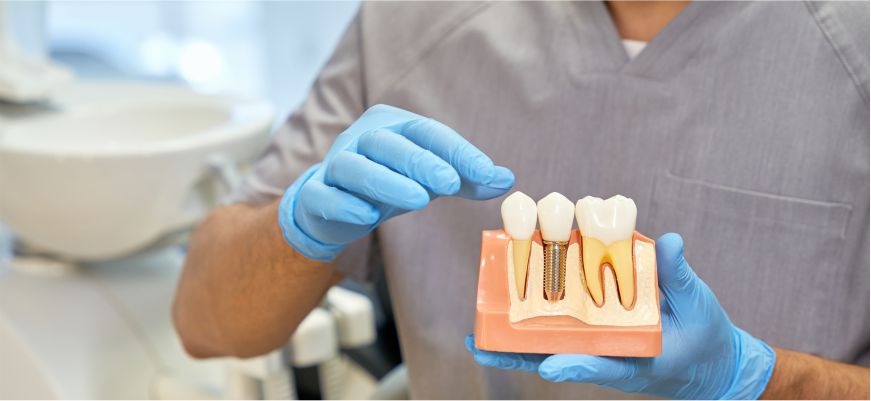 dental implants in bucks county