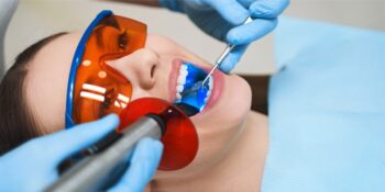 How Long Do Root Canals Last?