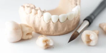 Porcelain-Fused-to-Metal (PFM) crowns suitability for dental restoration