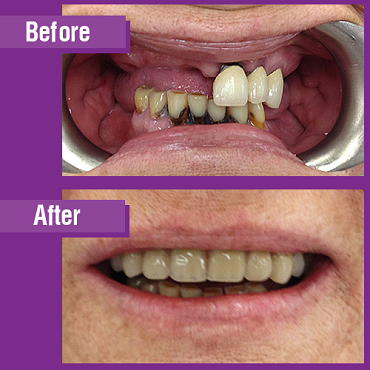 Dental Implants Before and After Bucks County