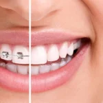 Invisalign Vs Braces