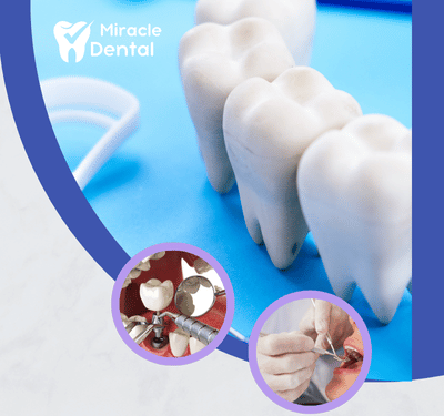 Teeth in a day