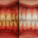 Deep Dental Cleaning Before and After