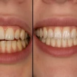 Invisalign Overbite Before and After