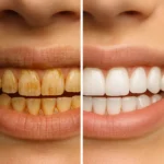 Teeth Whitening Before and After: