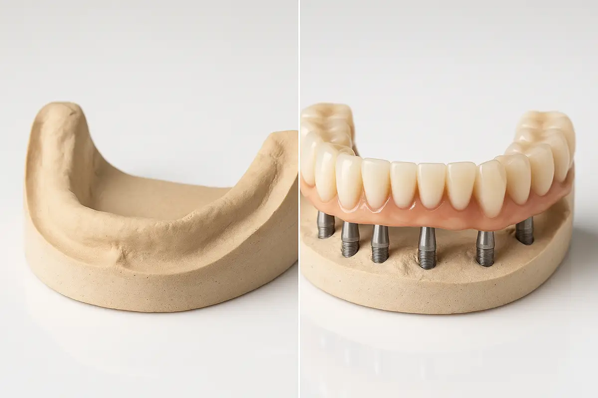 Are Full Mouth Dental Implants Worth It